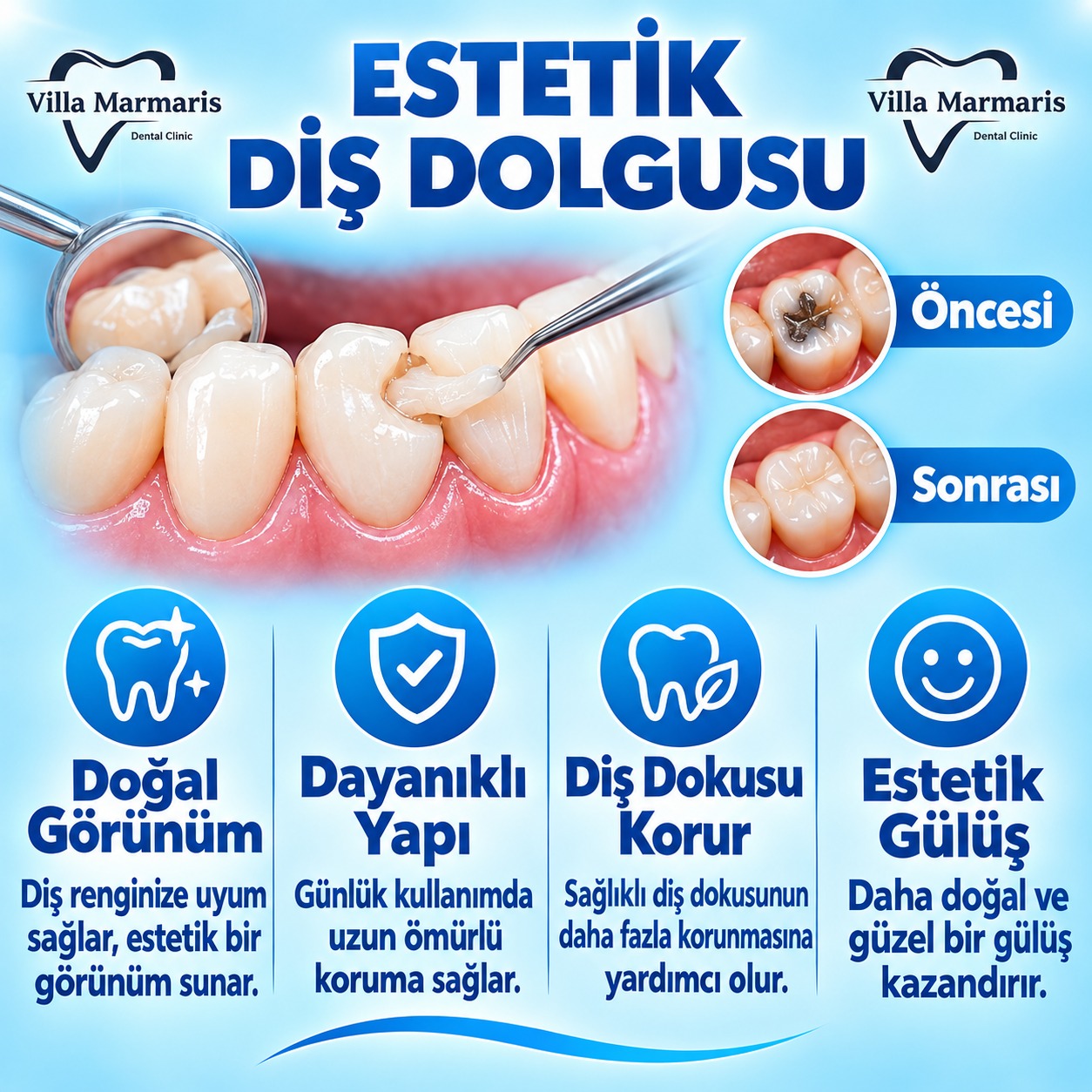 Estetik diş dolgusu