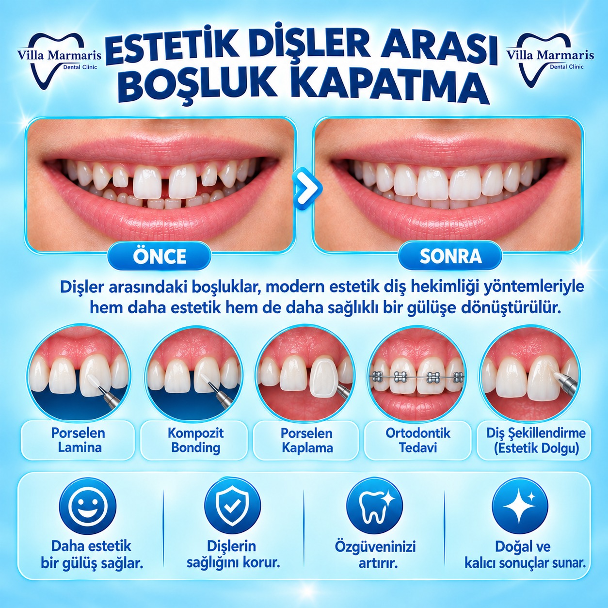 Dişler arası boşluk kapatma