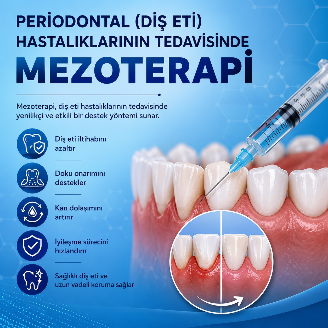 Periodontal hastalıklarda mezoterapi