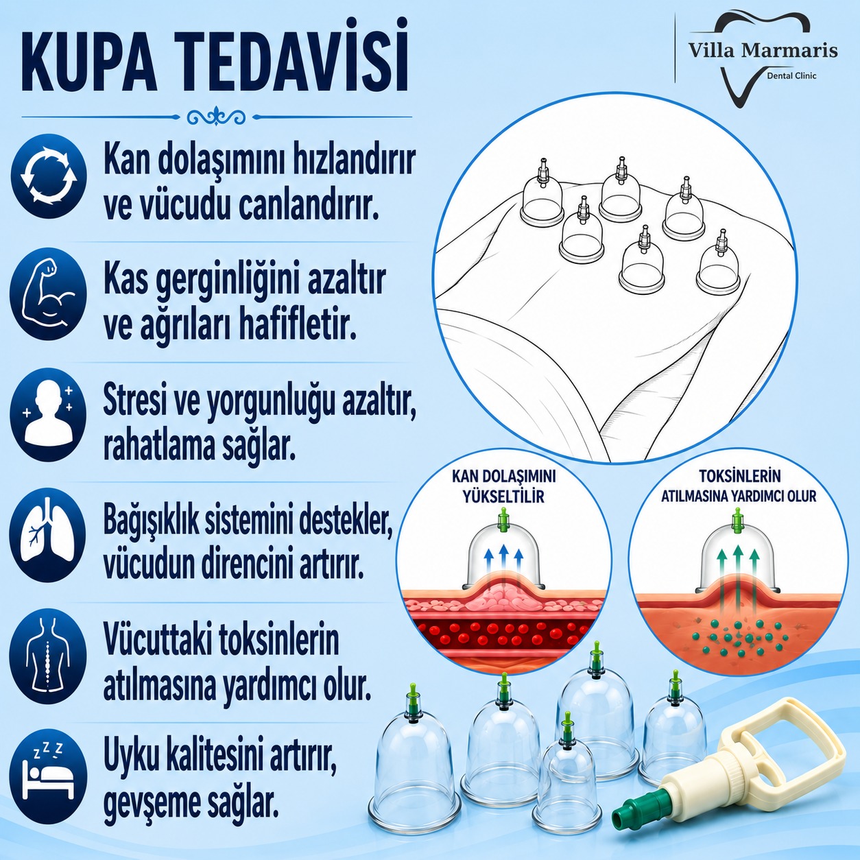 Kupa tedavisi